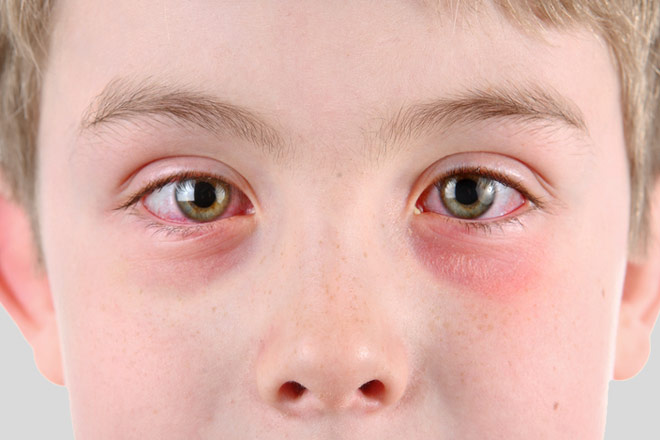 Lečenje crvenila oka – konjuktivitis
