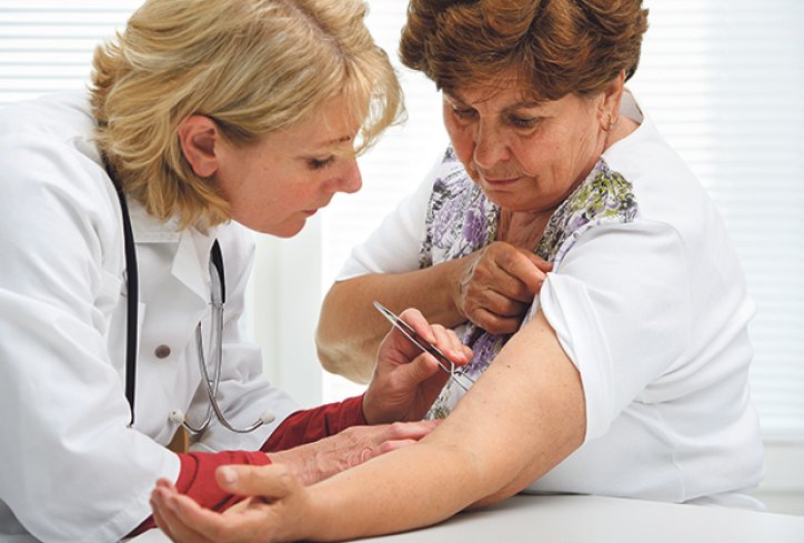 Krpelj se vadi bez uvrtanja!