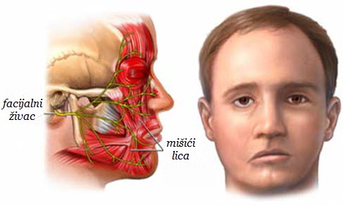 Promaja nije krivac za paralizu lica