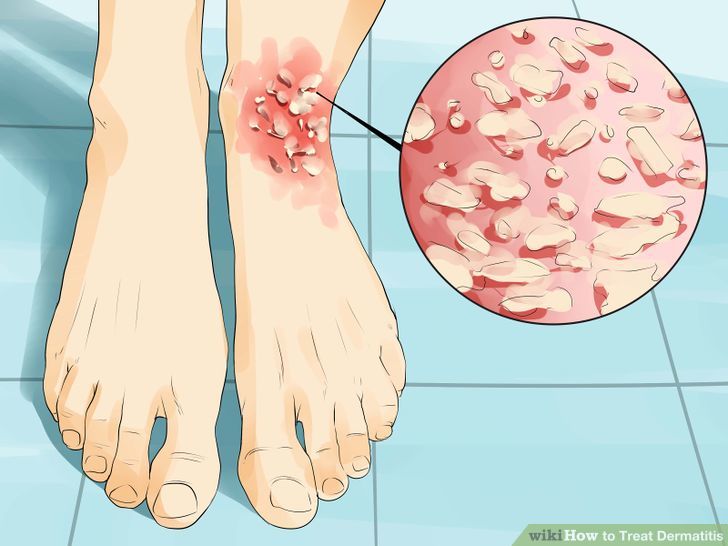 Neurodermatitis simptomi, uzrok, lečenje