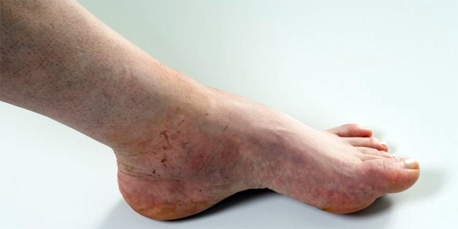 Lekoviti čaj protiv gihta