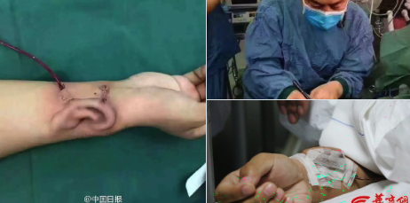 Izraslo mu UVO na ruci, a doktori će ga PRESADITI na glavu!