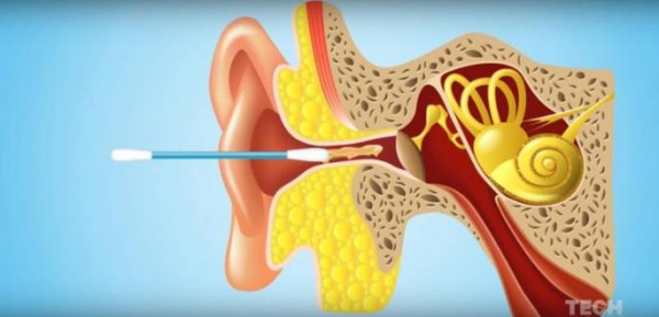 čistiti uho štapićem