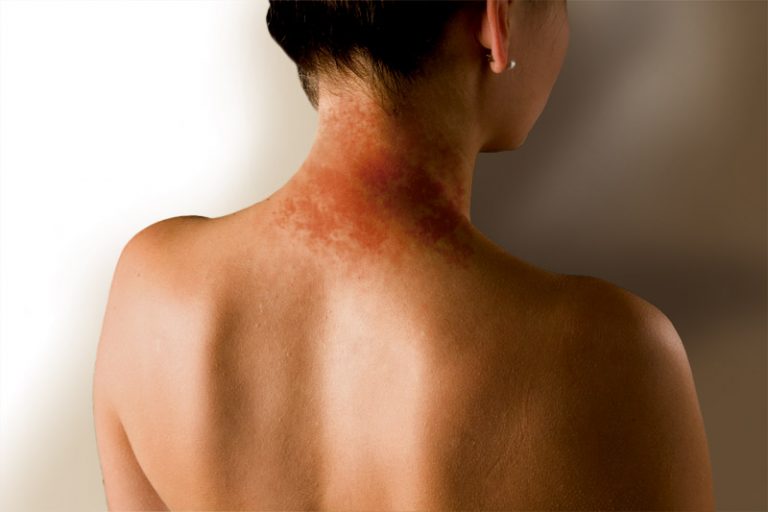 Neurodermatitis – uzroci, simptomi i lečenje
