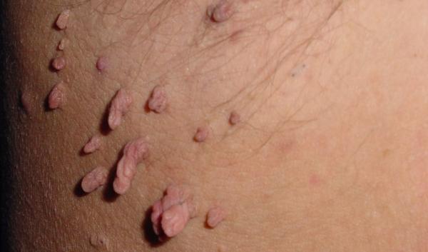 Lečenje bradavica- Saveti