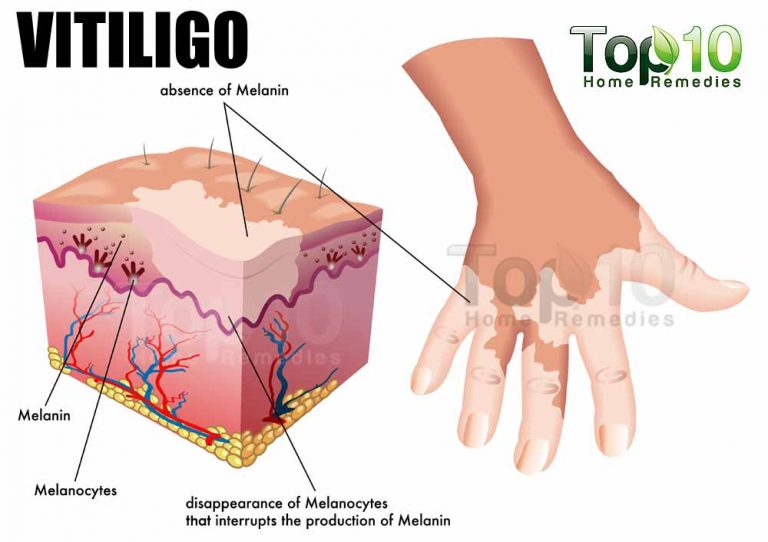 Lek koji ublažava VITILIGO