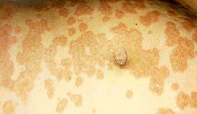 Gestacijski herpes