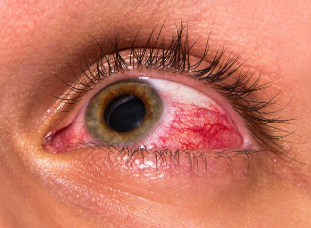 Konjuktivitis- lečenje biljkama