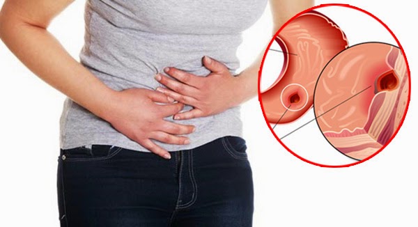 Namirnica koja leči čir na želucu