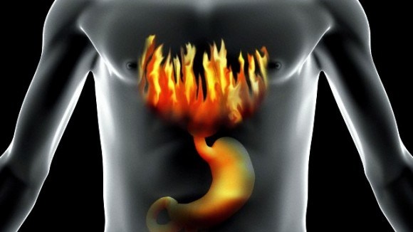 Način kako da se leči gastroezofagealna refluksna bolest ( GERB )