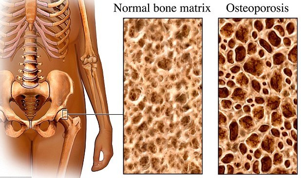 Osteoporoza- Lečenje