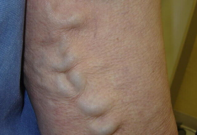 Lečenje tromboze dubokih vena