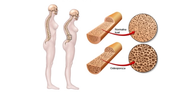 Osteomalacija- Simptomi i lečenje
