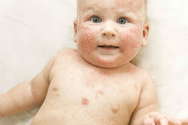 Simptomi i lečenje atopijskog dermatitisa