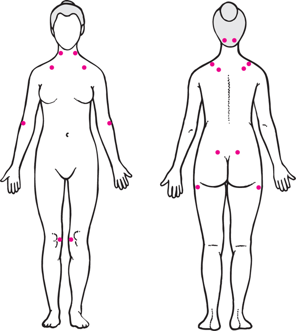Fibromialgija- simptomi i lečenje