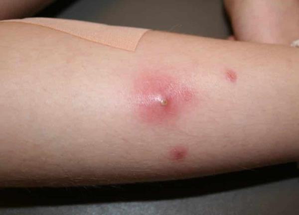 Lečenje čireva na koži