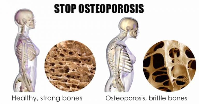 Na ove načine možete sprečiti osteoporozu