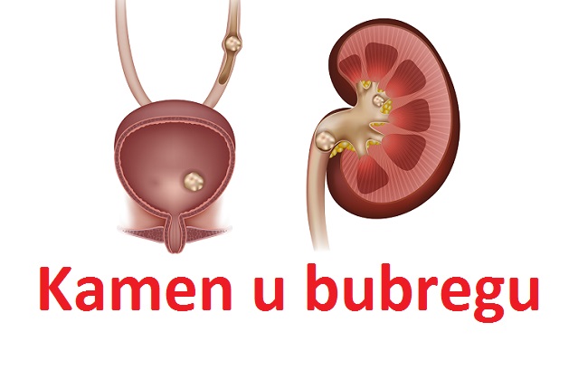 Prirodni način za topljenje kamena u bubregu i žuči