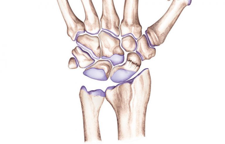 Ovo niste znali o osteoporozi