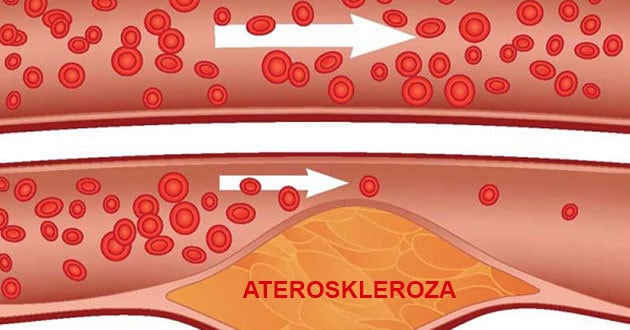 Prirodni lekovi protiv arteroskleroze
