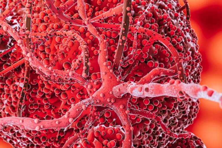 Aneurizma aorte